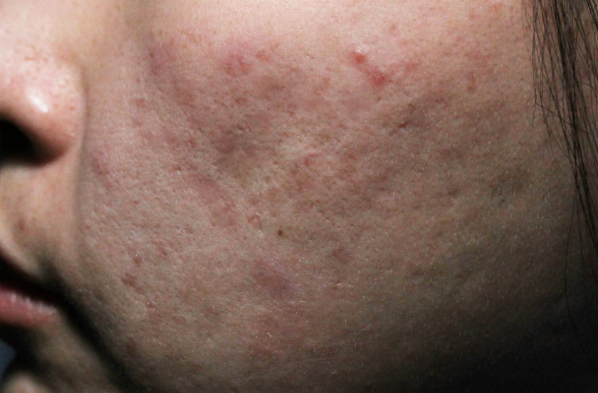여드름흉터4.JPG