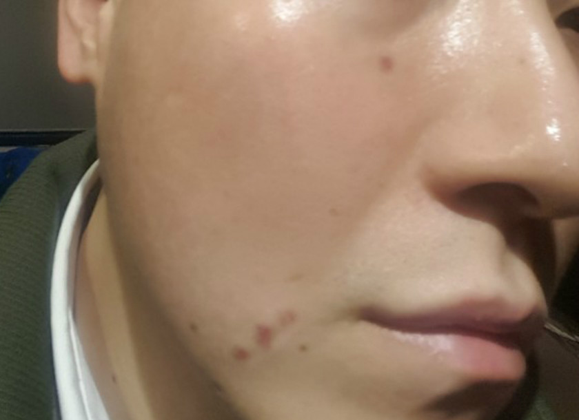 수두흉터수두자국치료받고 1주일후.JPG