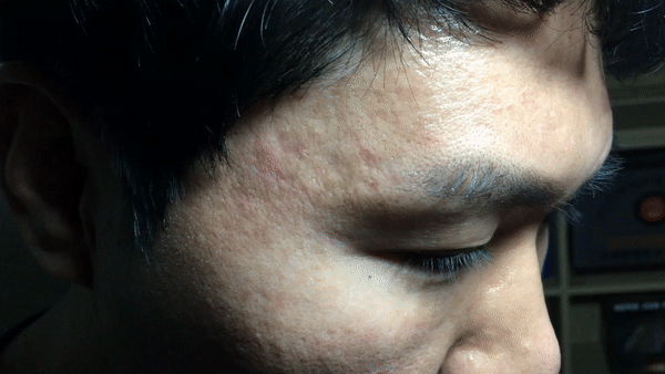 [움짤] 치료후.gif