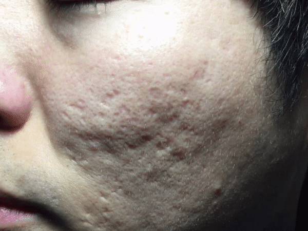 왼쪽_치료전 움짤.gif