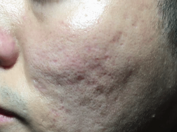 왼쪽_치료후 움짤.gif